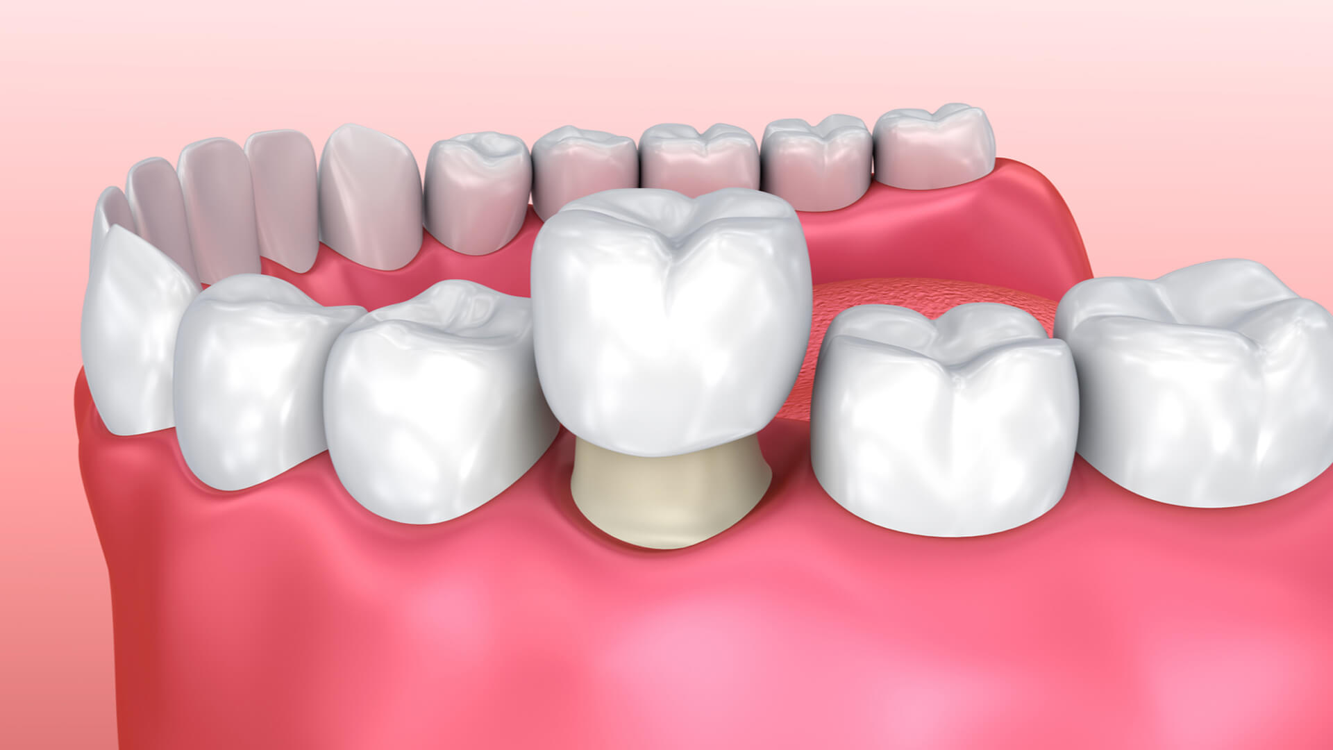 Dental Crowns Services