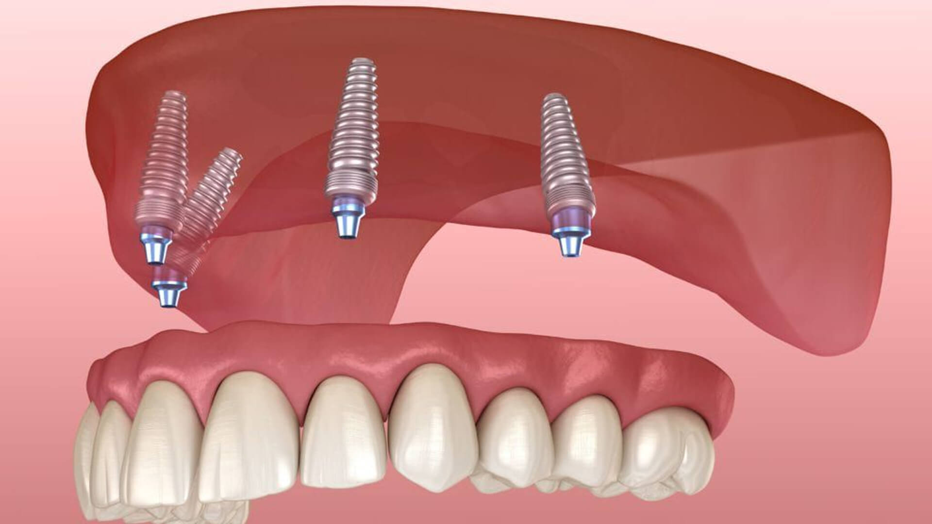 Dentures- False Teeth - Services Lucknow