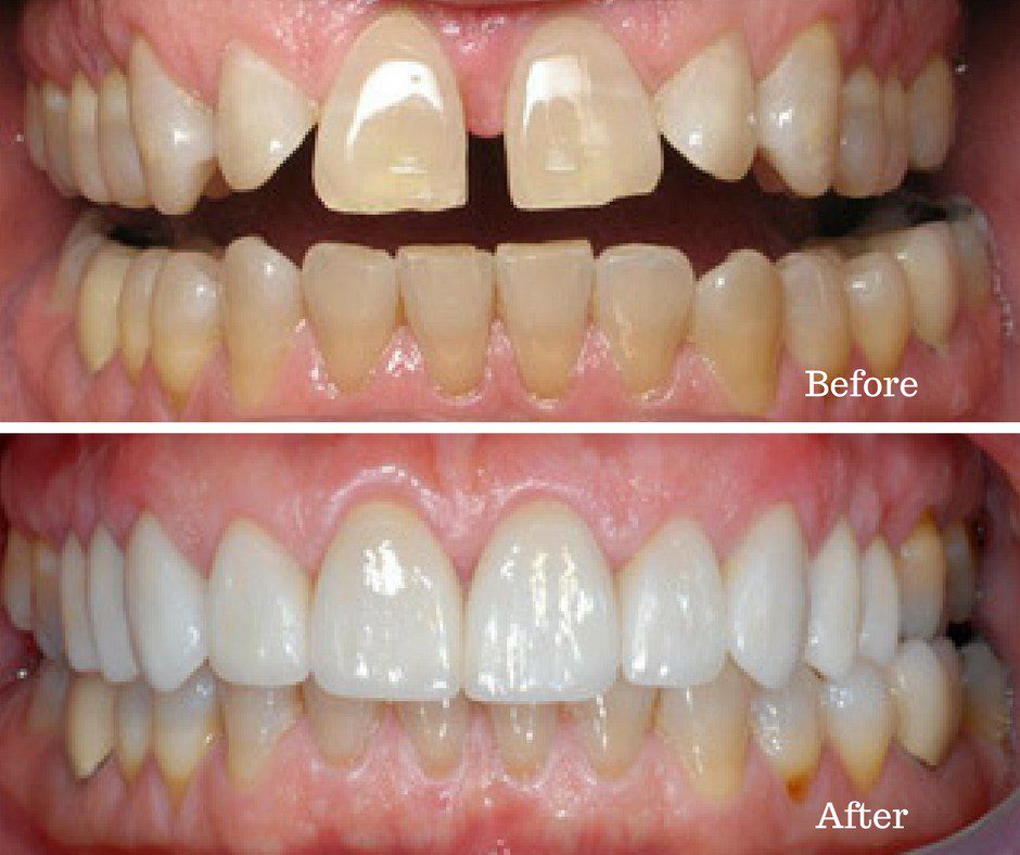 Before & After Picture Gallery - Smile Designing Services