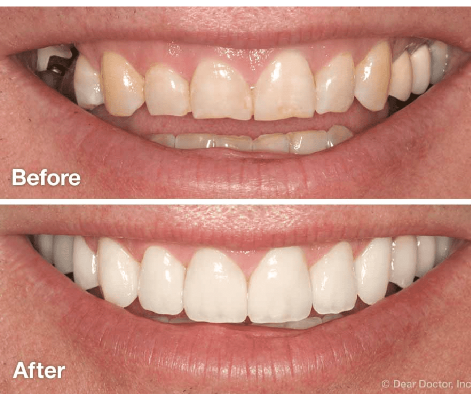 Smile Makeover Before & After - Gallery