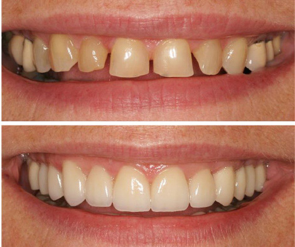 Before & After Picture Gallery - Smile Designing Services