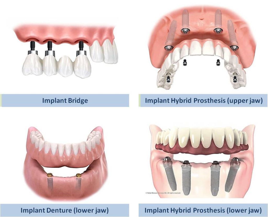 Dental Implant treatments are available​