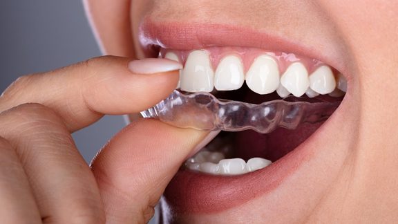 Teeth Straightening & Invisible Aligners