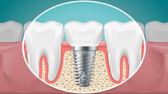 Dental implants crowns missing