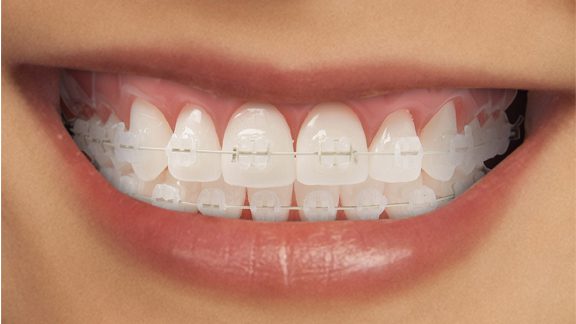 Tooth Colored Braces