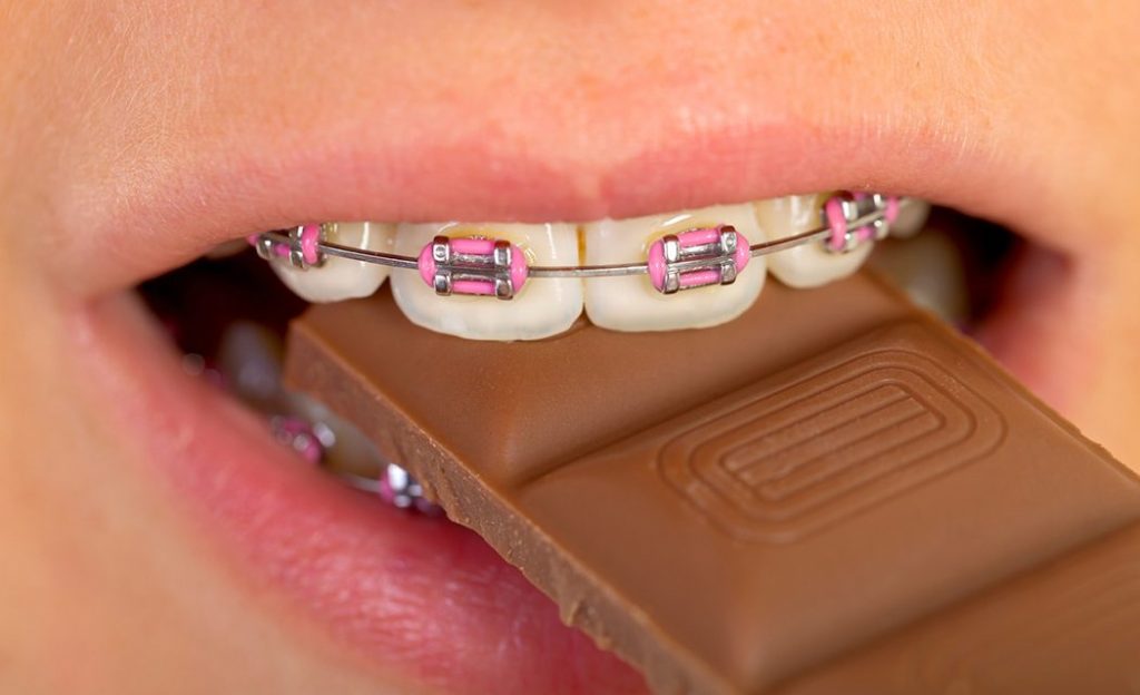 Can one eat normal food while wearing teeth braces?