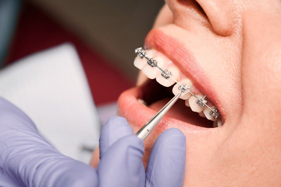 How long will my braces treatment take?