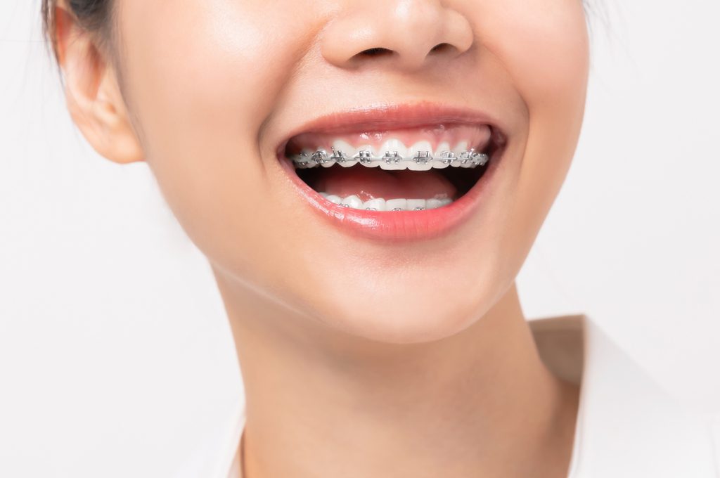 The Latest Technology for Braces Solutions – Cost of Teeth Braces In Lucknow
